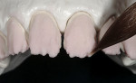Figure 21  Using the modified Geller cast during the porcelain application process.