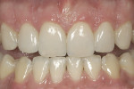 Figure 24  The final esthetic outcome of porcelain veneers placed on teeth Nos. 6 through 11.