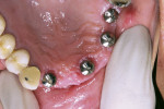Figure 1  Lingual view of implant placement.