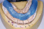 Figure 3  The implant core jig for insertion of implant cores in the patient's mouth.