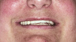 Figure 8  Postoperative smile view.