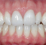 Figure 6 Retracted view after final cementation of lithiumdisilicate crowns on teeth Nos. 8 and 9.