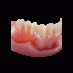 DuraTek Flexible Frameworks by Drake Precision Dental Laboratory