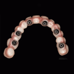 Opalite™ Screw-Retained Prosthetic Bars by Aurum Ceramic Dental Laboratories LLP