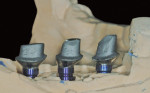 Figure 10 CAD/CAM abutments in place on the Robocast.