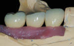 Figure 13 CAD/CAM abutments and PFM crowns seated on the Robocast with soft tissue.