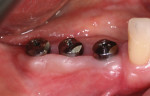 Figure 1 Clinical view of coded healing abutments on implants placed in site Nos. 28 through 30.