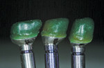 Figure 11 The wax-up for the PFM crowns performed on the CAD/CAM abutments.