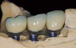 Figure 12 CAD/CAM abutments and PFM crowns seated on the Robocast.