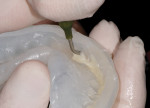 Figure 15 The Reveal material was placed into the matrix, with care taken to ensure complete and precise coverage of all tooth areas.