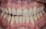 Figure 3 To demonstrate for the patient the manner in which his smile could be improved, digital smile design techniques and Photoshop applications were used to visualize proposed changes to his teeth.