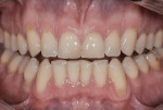 Figure 1 Close-up preoperative view of the patient’s teeth demonstrating wear, improper inclination, and other esthetic issues.