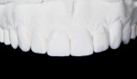 Figure 5 An enhanced design wax-up model was created demonstrating improved tooth length and inclination.