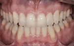 Figure 4 Similarly, Photoshop applications were used to demonstrate how bleaching or a lighter and brighter tooth shade would change the appearance of his smile.
