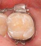 Figure 5 This photograph shows a 6-year recall of a molar sealed with Embrace WetBond pit and fissure sealant, depicting long-lasting benefit to tooth structure. (photo
courtesy of Joseph P. O’Donnell, DMD)