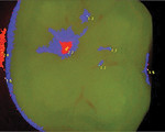 Figure 3 Finally, this image, recorded 6 months after the image in Fig 2 was taken, shows a reading of 2.2 on the algorithm scale. The yellow center surrounded by red and blue indicates that the caries has advanced into a lesion that now exhibits a “stick” when using a sharp explorer. The lesion has progressed over a 14-month period and now requires treatment that could have been avoided with early preventive measures.