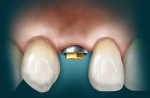 Figure 1  Illustration of an implant placed without diagnosis or correction of altered passive eruption.