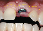 Figure 2  Clinical photograph of an implant placed without correction of altered passive eruption 5 weeks postoperatively.