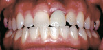 Figure 4  A transitional single-tooth removable appliance in place. The patient was referred to evaluate excess hyperplastic tissue on adjacent teeth and the implant because the teeth looked 