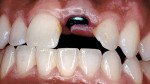 Figure 5  Intraoral view with the transitional appliance removed. Note the inflammation and grayish color where the implant collar is showing through the gingival tissue. Also note the altered passive eruption on adjacent teeth that was not corrected