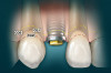 Figure 14 View of the patient’s fractured incisal edges on teeth No. 8 and No. 9, with wear and diastemas between them.