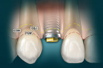 Figure 6  This illustration shows that if tissue were to be removed then several threads of the implant would be exposed. According to the implant surgeon, 3 mm on the facial from the facial crest of the bone to the gumline and 4 mm interproximally f