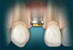 Figure 7  Diagram of the COB at the CEJ. This case should have had a crown-lengthening procedure to relocate the COB 2 mm to 3 mm apical to the CEJ following the contour of the tooth's CEJ to reestablish proper biologic width.