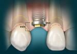 Figure 8  Diagram showing the implant placed after crown lengthening was performed immediately before placement of the implant. Once the COB was properly located apical to the CEJ in a parabolic fashion, the 