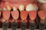 Figure 5 Gum shade is chosen for gingival porcelain additions to implant prosthesis.