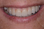 Figure 8 Final smile with completed veneers, crown, and removable partial denture, Note the subtle appearance of the clasps.