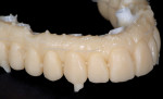 Figure 13 Duplicate of the wax-up in A3 Dentin composite, immediately after injection.