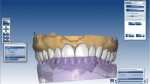 Figure 4 and Figure 5 The occlusion is adjusted using the Artex® Virtual Articulator and the Ceramill Mind software.