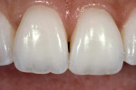 Figure 13  A patient with excellent papillae and parallel roots but an open gingival embrasure.