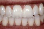 Figure 15  A 2-year recall of the direct composites to close the gingival embrasure.