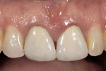 Figure 16  A patient who desires replacement crowns on both central incisors.