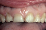 Figure 20  A patient with wear and some secondary eruption; papilla levels are good but the gingival scallop, particularly on the centrals, is flat.