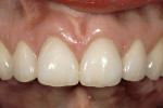 Figure 23  A 5-year recall. Note the excellent papilla height to contact length relationship from facial surgery and lengthening the incisal edges.