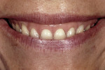 Figure 24  A patient with severe tooth wear and secondary eruption. The incisal edges are correctly related to the face but the papilla and free gingival margin levels need to move apically.