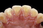 Figure 5  Due to the lack of tooth structures for restoration, crown lengthening was chosen to move the papilla and gingival margin.