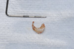 Figure 11 Ring of cement that was removed from the peri-implant site appearing to be resinous in consistency.