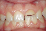 Figure 3  Class 4 fracture of maxillary central incisor.