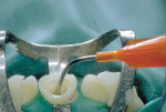 Figure 6  Application of dual-cure resin cement to the root canal.