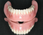 Figure 8 Processed mandibular bar-retained overdenture.