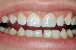 Figure 7  Completed direct-adhesive, composite-resin restoration for maxillary central incisor.