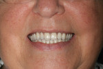 Figure 12 Completed maxillary and mandibular overdentures in occlusion.