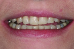 Figure 3 Pre-restorative 1:3 full smile. Note the irregular incisal wear on both the maxillary and mandibular teeth.