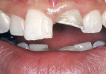 Figure 8  Maxillary central incisor fractured at the gingival line.*
