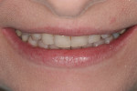 Figure 6 The tip down smile. This photo aids in determining the proper horizontal incisal edge position.