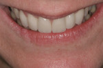 Figure 19 Postoperative tip down smile. Note the incisal edges are now at the vermillion border of the lower lip.