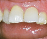 Figure 11  All-ceramic crown after cementation.*
